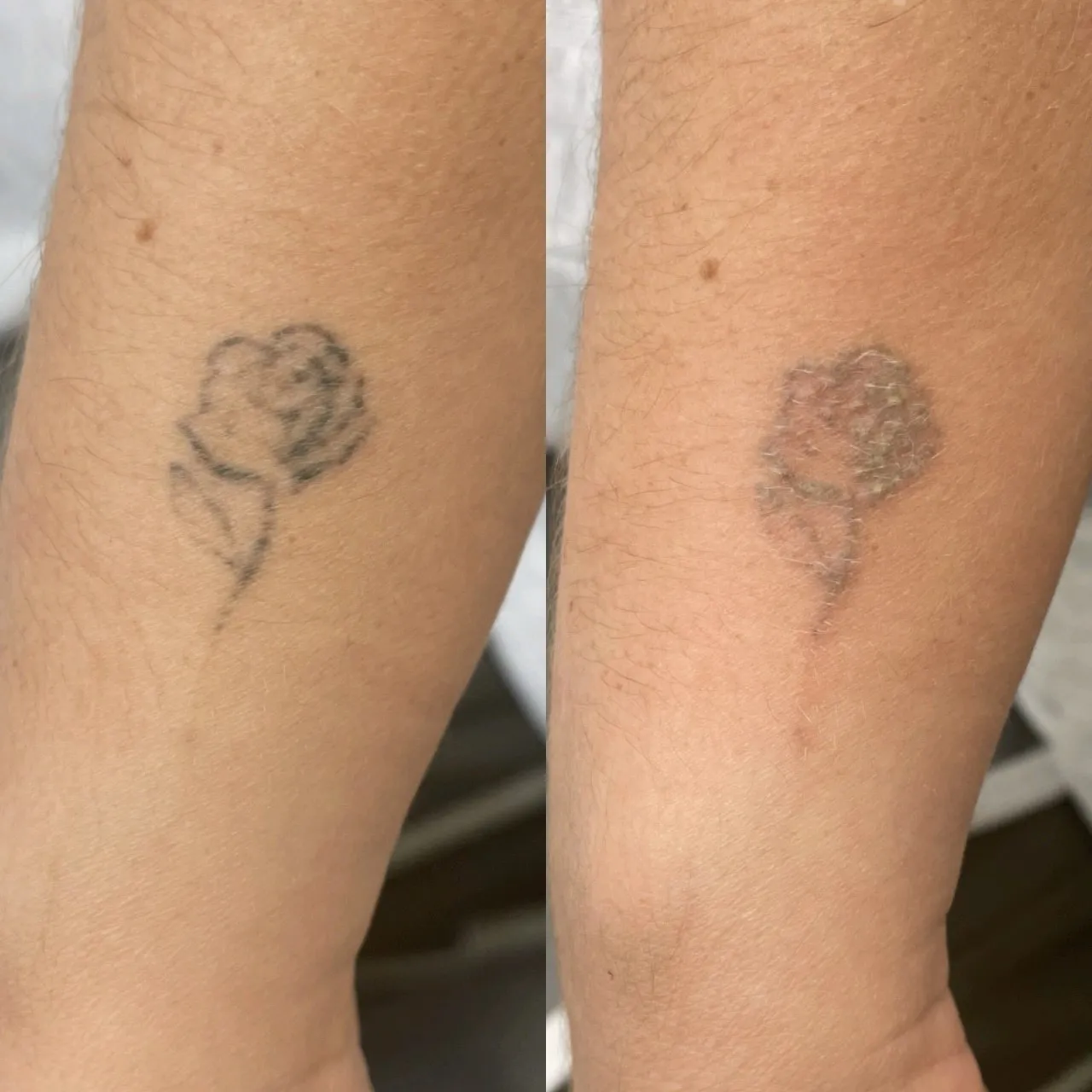 What to Expect During Your First Tattoo Removal Session in Coventry